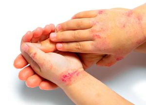 Dermatitis Atópica: ¿De qué trata la enfermedad que le impide el sueño a los más chicos?